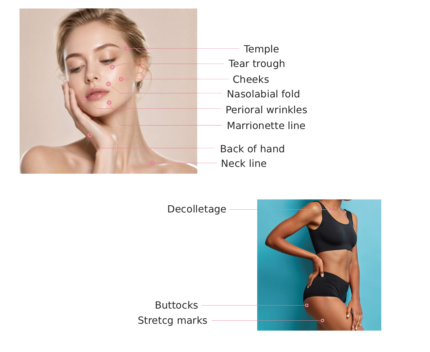 Sculptiva PDLLA + HA recommended application areas